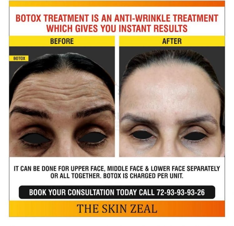BEST BOTOX CLINIC IN CHANDIGARH